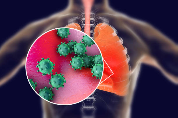 Viruses in human lungs Viruses in human lungs, 3D illustration. Conceptual image for viral pneumonia, flu, MERS-CoV, SARS, Adenoviruses and other respiratory viruses bronchitis stock pictures, royalty-free photos & images