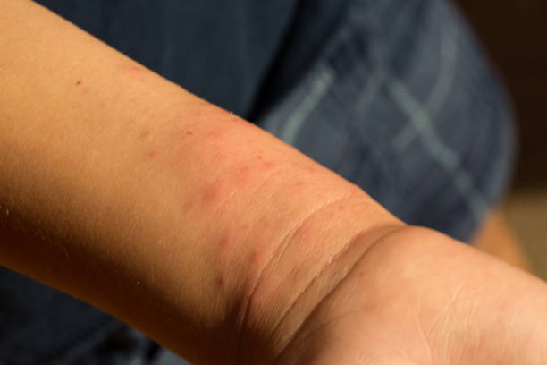 istock Toddler with many bug bites and rash 943472570