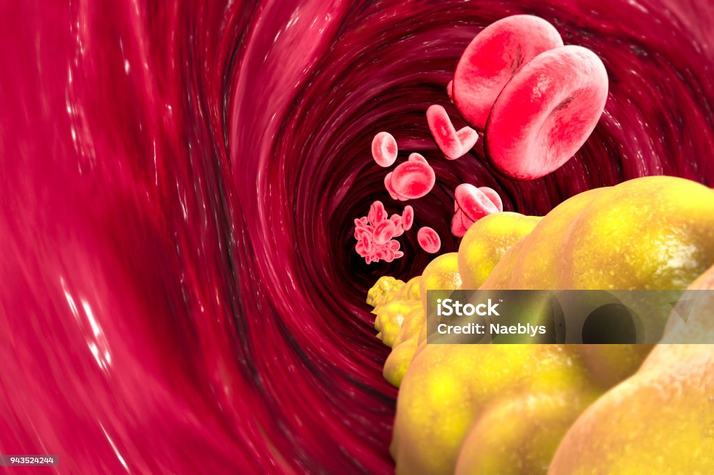 Cholesterol formation, fat, artery, vein, heart Cholesterol formation, fat, artery, vein, heart. Narrowing of a vein for fat formation Cholesterol Stock Photo