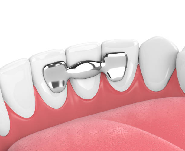 istock 3d render of jaw with teeth and maryland bridge 943642280