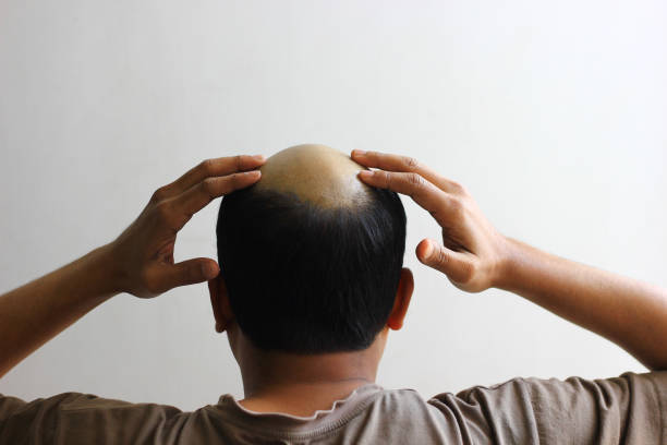 bald man in isolated white background worried and both hands on his scalp.view from behind bald man in isolated white background worried and both hands on his scalp.view from behind wig stock pictures, royalty-free photos & images