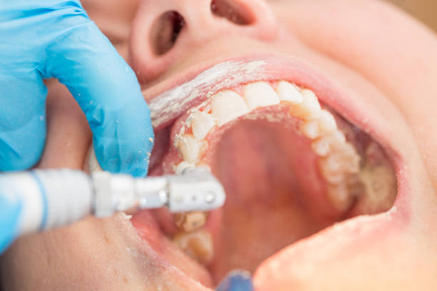 close-up procedimiento limpieza dental de piedra pómez - piedra pumice fotografías e imágenes de stock