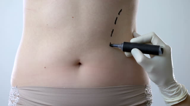 Liposuction Video