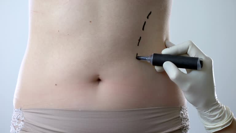 Liposuction Video Liposuction Video
