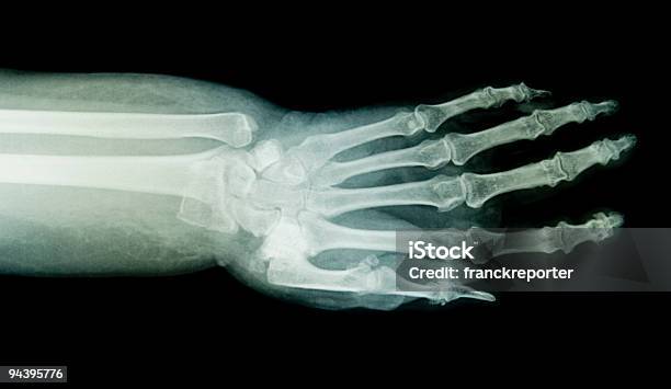 Xray De Mano Foto de stock y más banco de imágenes de Anatomía - Anatomía, Arterioesclerosis, Articulación humana