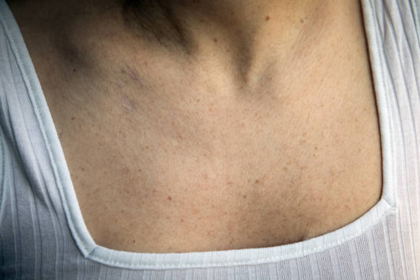 istock Women with skin pigmentation 944069386