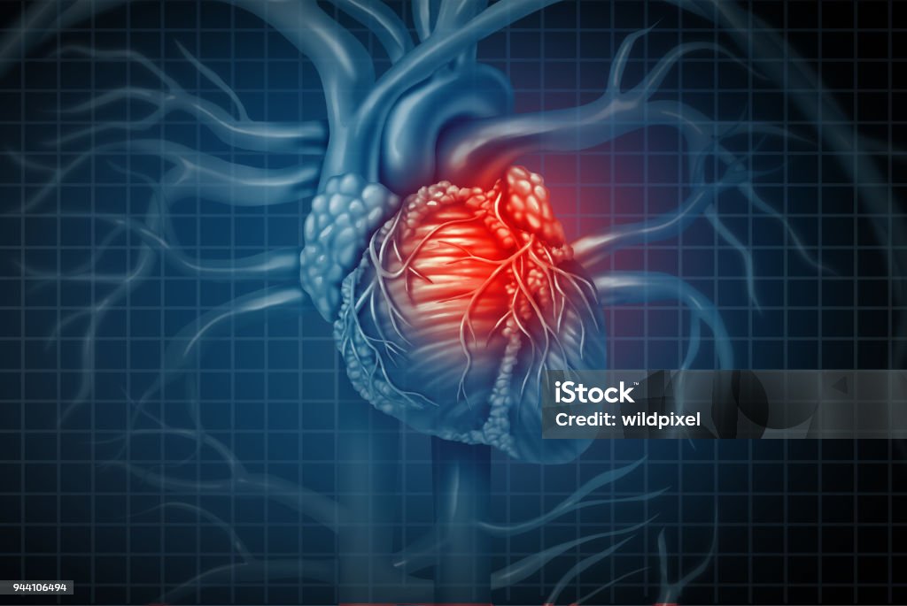 Heart Attack Heart attack pain as a human cardiovascular organ with a painful cardiac inflamation with 3D illustration elements. Heart Attack Stock Photo