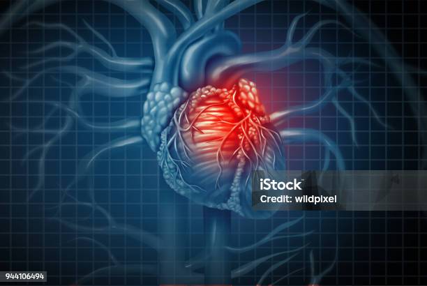 Heart Attack Stock Photo - Download Image Now - Heart Attack, Infarction, Myocardium