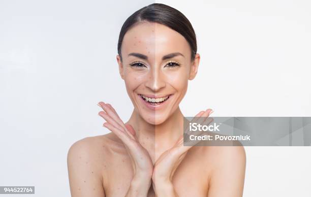Acne Skin Problems Two Different Halves Of The Face Stock Photo - Download Image Now