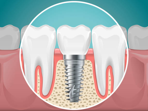 ilustraciones, imágenes clip art, dibujos animados e iconos de stock de ilustraciones de estomatología. implantes dentales y dientes sanos - teeth implant