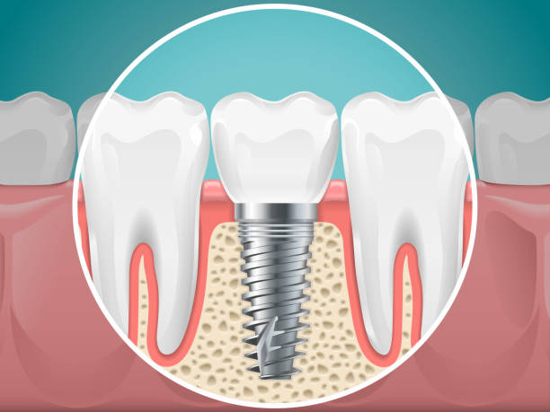 стоматологические иллюстрации. зубные имплантаты и здоровые зубы - teeth implant stock illustrations
