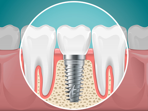 Stomatology illustrations. Dental implants and healthy teeth. Vector health tooth and implant stomatology, dentistry installation and fixture