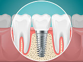 Stomatology illustrations. Dental implants and healthy teeth