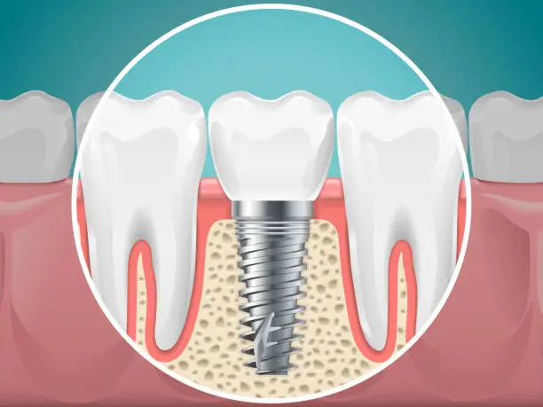 Vector illustration of Stomatology illustrations. Dental implants and healthy teeth