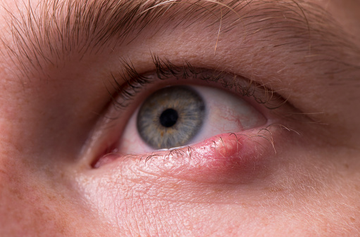 Close up of a man's eye with a stye, bacterial infection of an oil gland in the lower eyelid.
