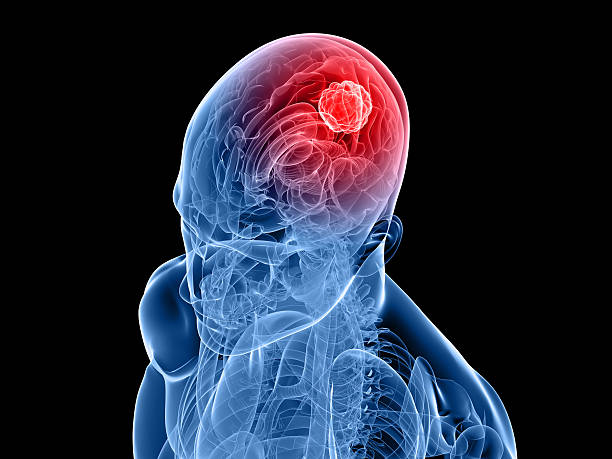 A 3-D image of a human skull and brain depicting cancer stock photo