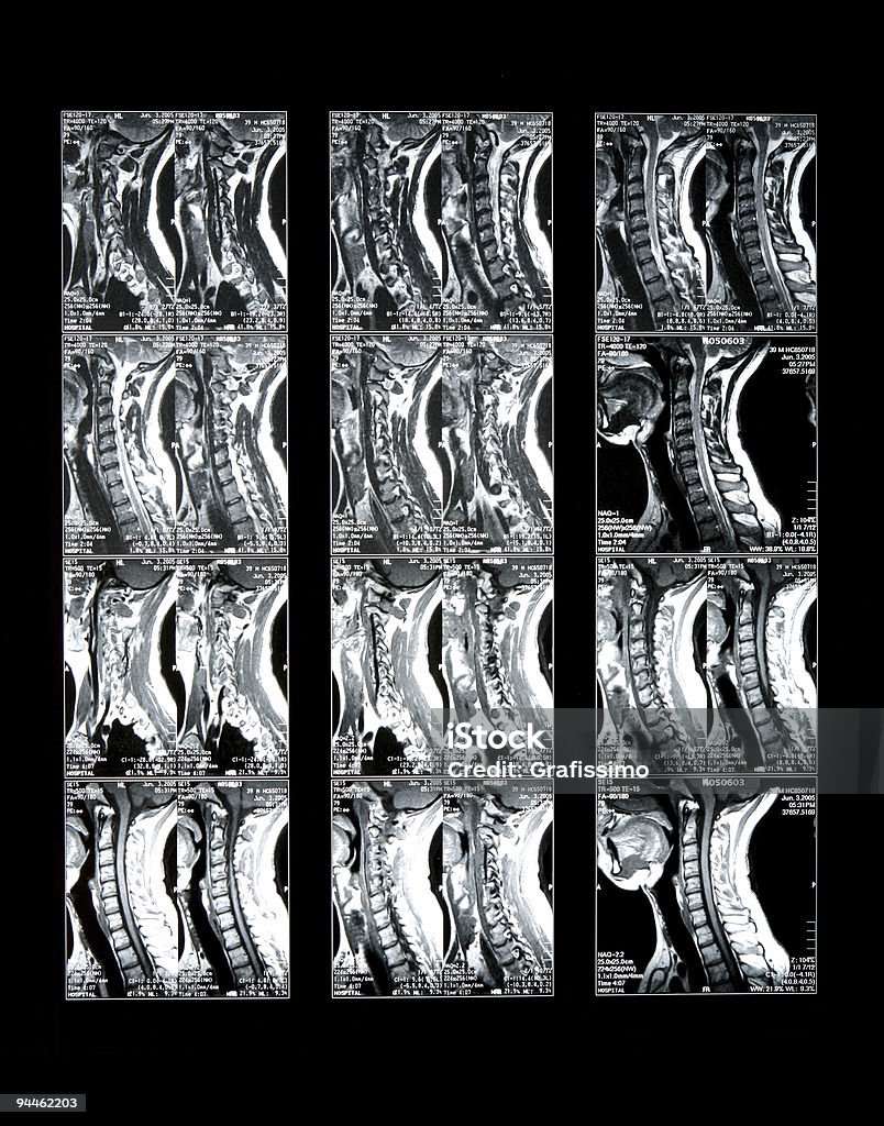 Magnetischer Resonanz Hals bones - Lizenzfrei Magnetresonanztomograph Stock-Foto