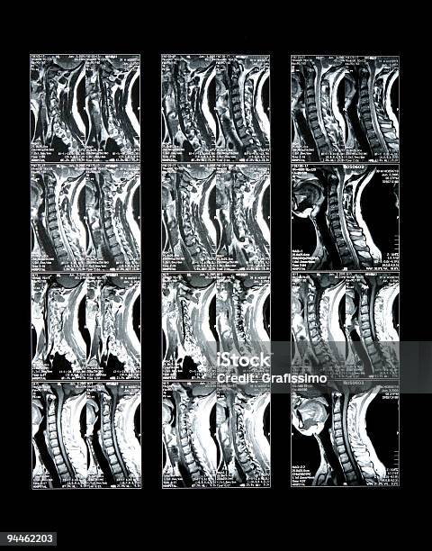 Ressonância Magnética Do Pescoço Ossos - Fotografias de stock e mais imagens de Máquina de Ressonância Magnética - Máquina de Ressonância Magnética, Anatomia, Cabeça Humana