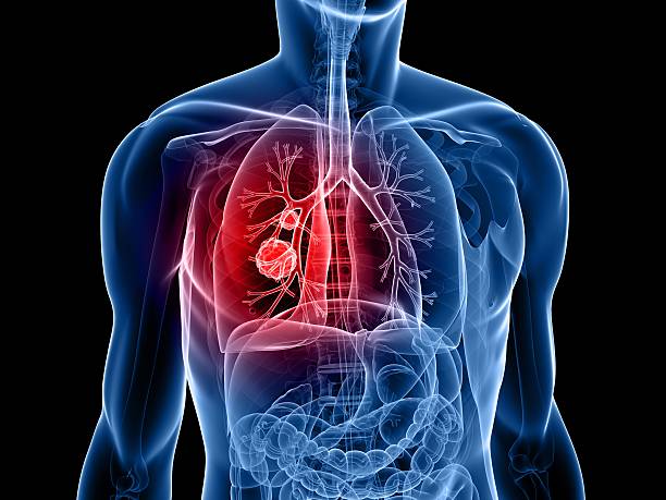 lung cancer - krebs tumor stock-fotos und bilder