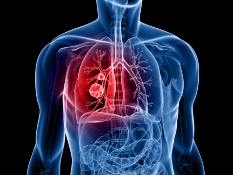 Cáncer de pulmón photo