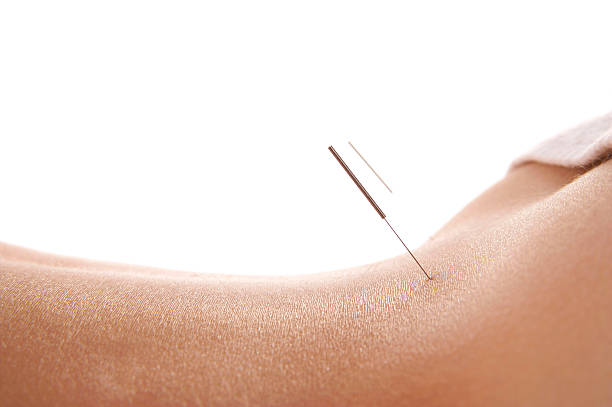 Photo of woman having acupuncture treatment. Alternative Medicine.