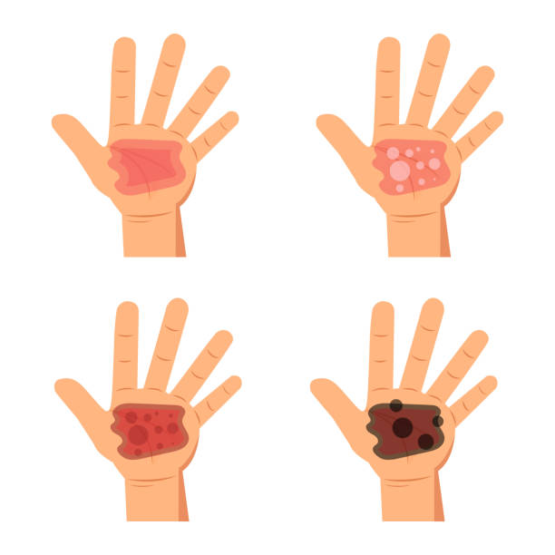 Ilustración de Quemaduras De Grado De La Piel Ilustración Vectorial Infografía y más Vectores Libres de Derechos de Piel - Partes del cuerpo - iStock Ilustración de Quemaduras De Grado De La Piel Ilustración Vectorial Infografía y más Vectores Libres de Derechos de Piel - Partes del cuerpo - iStock