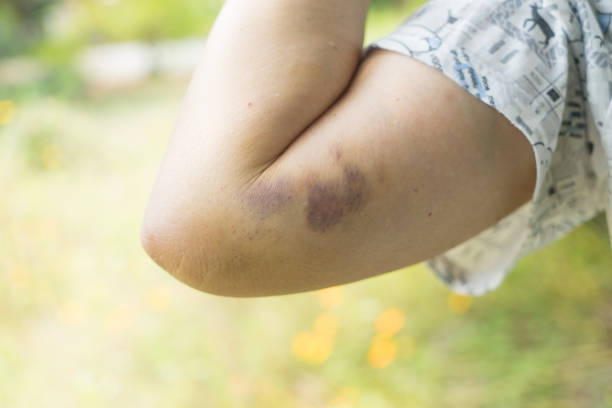 close up bruising on the old woman arm. woman violence concept, bruises on arm. - violence domestic violence victim women imagens e fotografias de stock