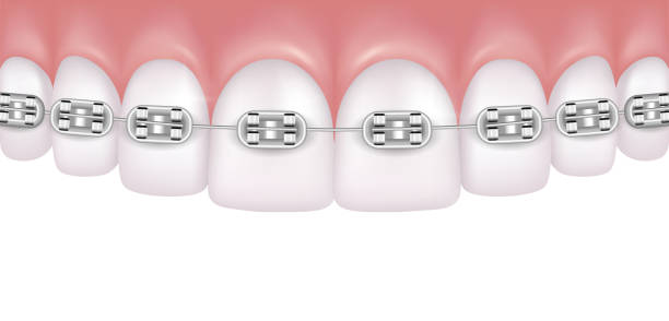Vector realistic perfect white teeth with braces isolated on white background Vector realistic perfect white teeth with braces isolated on white background orthodontist stock illustrations