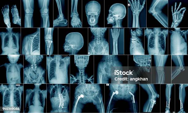 Collection Xray Multiple Area Stock Photo - Download Image Now - Medical X-ray, Bone Fracture, Human Skeleton