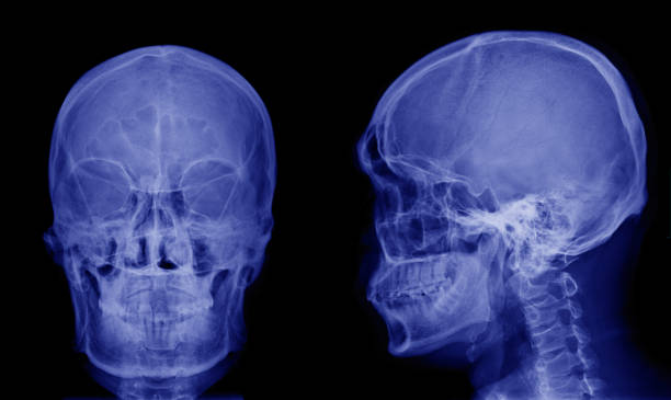 istock X-ray image of asian skull front view and side view 945203812
