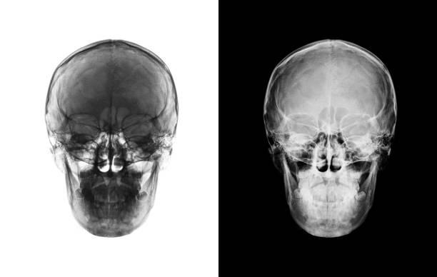 istock X-ray image of front view asian skull black and white 945203852