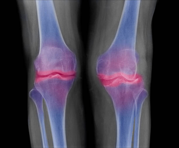 istock knee x-ray show Osteoarthritis(OA). Film on both side front view, narrow joint space ( cartilage loss ) osteophyte , subchondral sclerosis 945203856