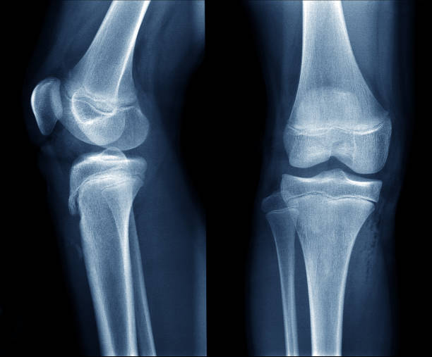 рентгеновское изображение нормального ребенка / подросткового колена показывают эпифизную пластину - tibia стоковые фото и изображения