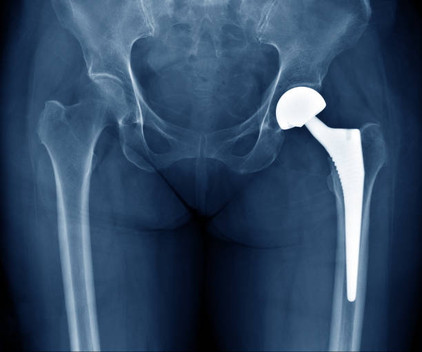 x-ray scan image of hip joints with orthopedic hip joint replacement implant head and screws in human skeleton in blue gray tones. scanned in orthopedics traumatology surgery hospital clinic - osteoarthritis doctor medicine healthcare and medicine imagens e fotografias de stock