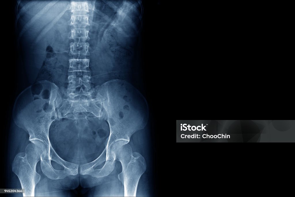 x-ray image of human normal spine, rips, pelvis, both hip joint and blank area at right side Spine - Body Part Stock Photo