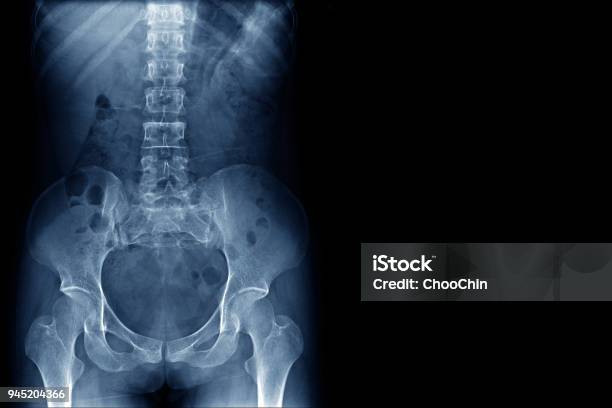 Xray Image Of Human Normal Spine Rips Pelvis Both Hip Joint And Blank Area At Right Side Stock Photo - Download Image Now