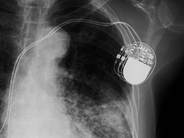 istock x-ray image of permanent pacemaker implant in body chest. 945204444