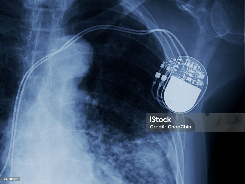 x-ray image of permanent pacemaker implant in chest body , process in blue tone Pacemaker Stock Photo