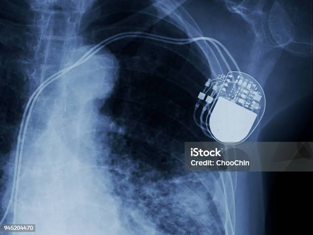 Xray Image Of Permanent Pacemaker Implant In Chest Body Process In Blue Tone Stock Photo - Download Image Now