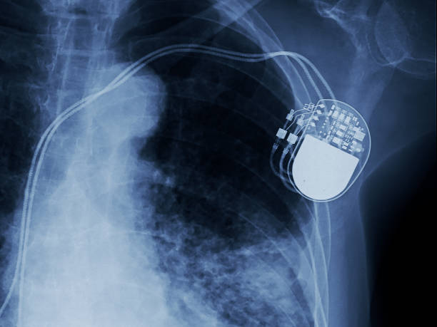 obraz rentgenowski stałego implantu rozrusznika serca w ciele klatki piersiowej, proces w niebieskim tonie - human heart x ray image anatomy human internal organ zdjęcia i obrazy z banku zdjęć