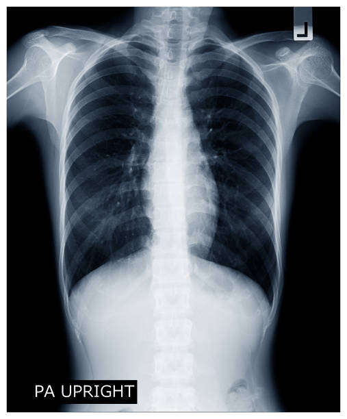 istock X-ray image of human body chest, very good quality 945204520