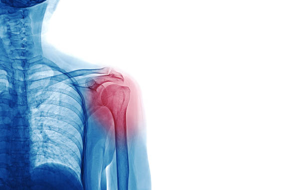 imagen de rayos x del paciente que tiene dolor de hombro aislado sobre fondo blanco, espacio para su mensaje y la idea concepto médico - pain shoulder physical injury sport fotografías e imágenes de stock