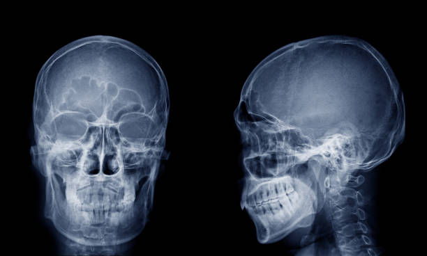 istock Very good quality X-ray image of normal human skull front (AP) view and side (Lateral) view, Process in blue tone isolated on black background. 945205362