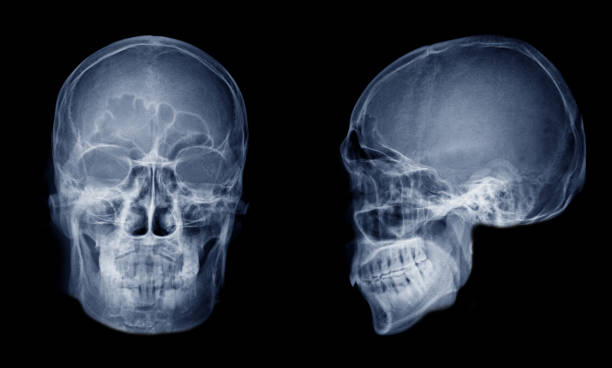 istock Very good quality X-ray image of normal human skull front (AP) view and side (Lateral) view, Process in blue tone isolated on black background. 945206596