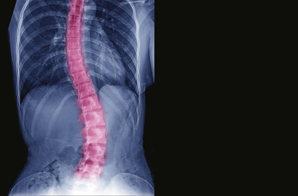 radiographie du rachis patient adolescent voir la scoliose et la courbure de la colonne vertébrale chez les jeunes. traiter en marque de colonne vertébrale de ton bleu dans la couleur rouge et copie espace, concept.ุ médicaux - scoliosis photos et images de collection