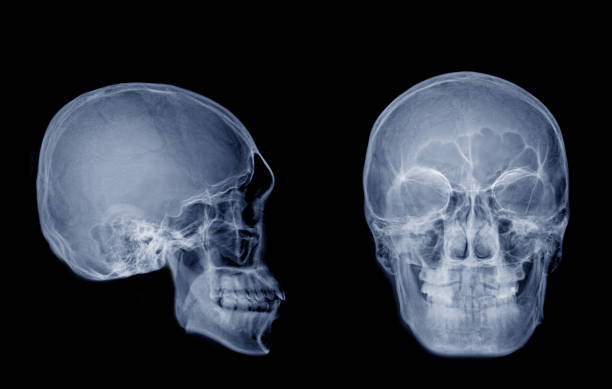 istock Very good quality X-ray image of normal human skull front (AP) view and side (Lateral) view, Process in blue tone isolated on black background. 945206666