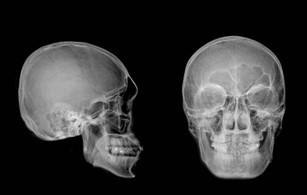 istock Very good quality X-ray image of normal human skull front (AP) view and side (Lateral) view, Process in normal tone isolated on black background. 945206672