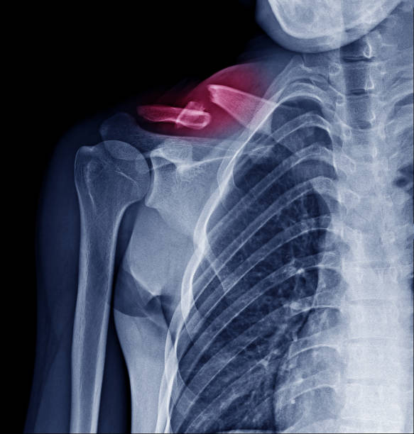 x-ray image de clavicule fracture marque rouge area - x ray x ray image shoulder human arm photos et images de collection