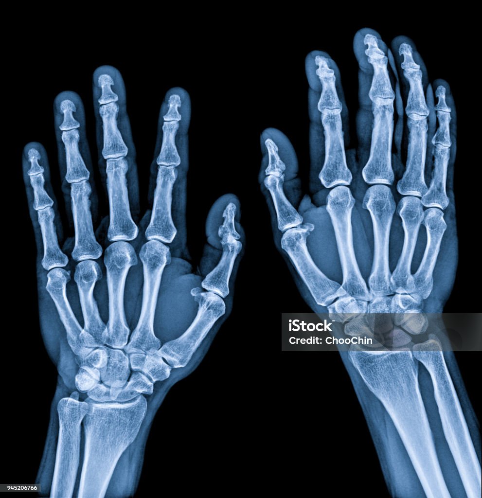 Normal male Hand x-ray both side process in blue tone Anatomy Stock Photo