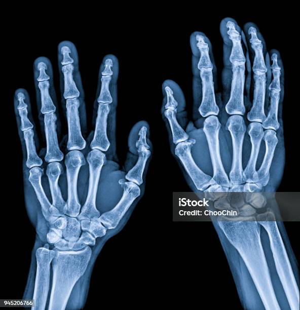 Normal Male Hand Xray Both Side Process In Blue Tone Stock Photo - Download Image Now